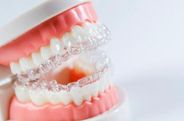 Close-up. Transparent aligners are placed over the teeth of an artificial jaw.