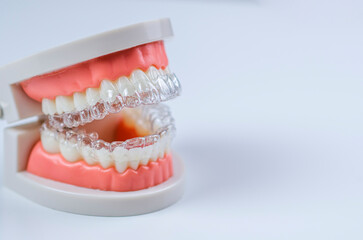 Close-up. Transparent aligners are placed over the teeth of an artificial jaw.