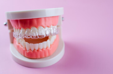 Invisible dental teeth brackets teeth aligners on blue background. Plastic braces dentistry retainers to straighten teeth on a pink background