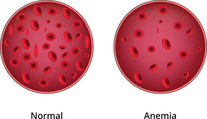 Normal Anemia Design Vector Illustration