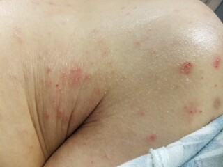Scabies excoriated skin lesions - close-up view