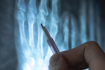 Doctor learning X-Ray Image of Human hands bones. Skeletal structure for medical analysis of...