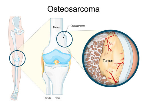 Osteosarcoma. Malignant bone tumor.