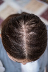 Naklejka premium Top of the head of young Asian woman after facing hair loss problem. Need to take medicine like zinc and biotin to make her hair grow faster and thicker. Alopecia.