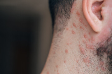 Fototapeta premium Adult man neck and body with strong aggressive varicella or chicken pox. Pink spots, papules, vesicles.