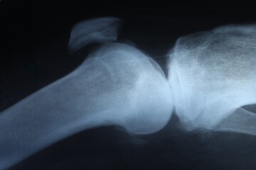 Obraz premium X-ray image of knee joint as background, closeup
