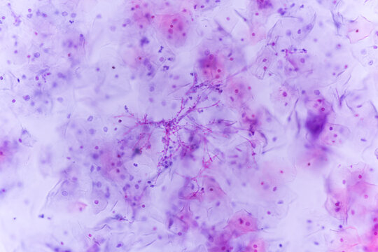 View in microscopic of Candidiasis, fungal infection (Yeast and Pseudohyphae form) in pap smear slide cytology and diagnostic by pathologist.Gynecology report and diagnosis.Sexually transmitted infect