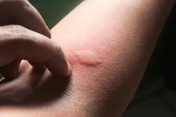 allergic skin bumps on hand