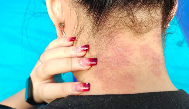 portrait the rash hives allergy and inflammation skin, reaction and urticaria, scar and freckles, urticaria stigma and eczema, epidermis blister rosacea on the neck, health care and medical concept.