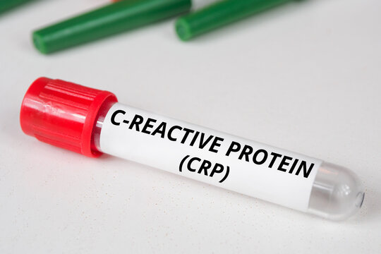 C-reactive protein (CRP)name of blood test