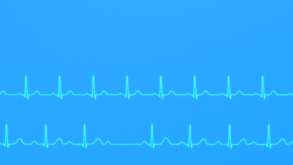 Comparison of ECG of normal heart rhythm and AV block 2nd degree
