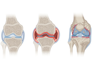 Knee Joint (Healthy, Osteoarthritis, Rheumatoid Arthritis)