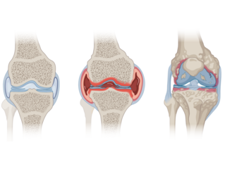 Knee Joint (Healthy, Osteoarthritis, Rheumatoid Arthritis)