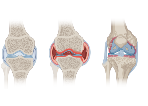Knee Joint (Healthy, Osteoarthritis, Rheumatoid Arthritis)