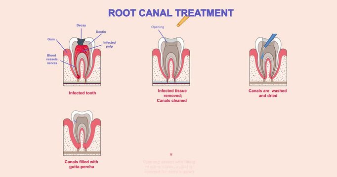 Root canal treatment. Moving banner with medical infographics and diagram with stages of dental caries treatment. Restoration of damaged teeth. Dentistry and stomatology. Flat animated graphics