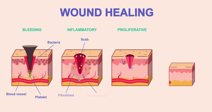 Wound healing process. Moving banner or medical infographic with stages of skin regeneration after injury. Bleeding, Inflammation, Proliferation and Remodeling. Cartoon flat animated graphics