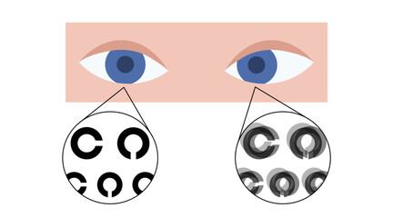 Amblyopia or lazy eye