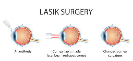 The process of laser eye surgery LASIK. Vision correction for nearsightedness, farsightedness, and astigmatism
