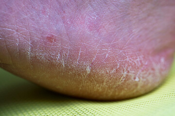 Rough human heels with calluses and very dry, cracked skin