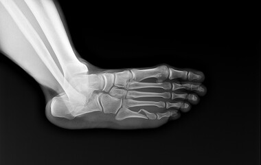 Obraz premium human foot ankel and leg xray picture