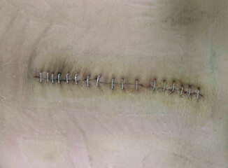 Surgery wound from Herniated nucleus pulposus operation of old asian woman and close wound by skin Stapler