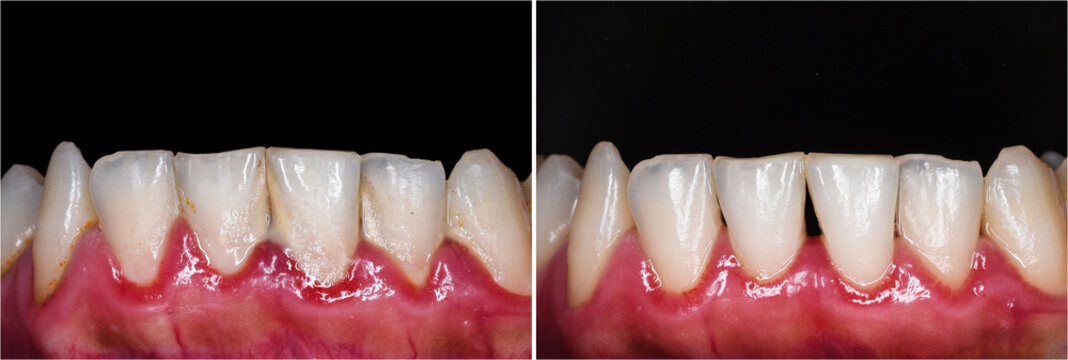 teeth tartar and calculus cleaning