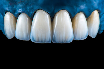 emax crowns and veneers