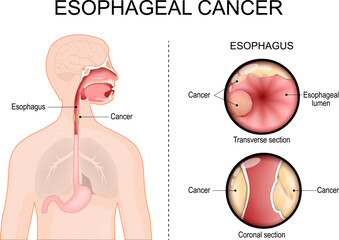 Obraz premium Esophageal cancer