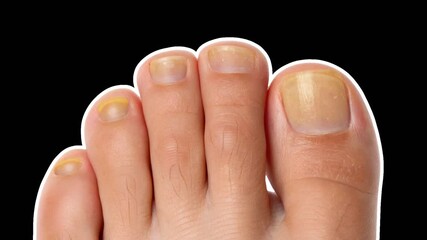 A human foot with sick yellow nails appears, with time the nails recover. Podiatrist concept. Empty space for text. Smooth animation on transparent background
