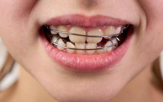 Little girl with teeth retainers looking at camera, close-up. Child with orthodontic plate or dental braces in her mouth. Children's dentistry