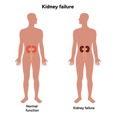 Fototapeta premium Kidney failure. Medical Kidney disease