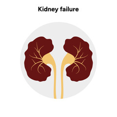 Kidney failure. Medical Kidney disease