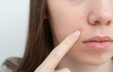 Close up of young woman pointing to a pimple on her cheek. Inflamed acne and post-acne marks and...