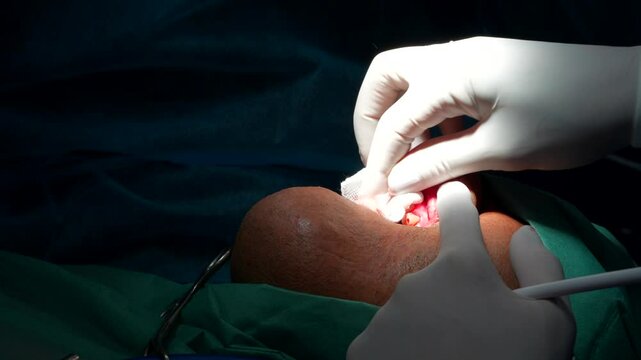 Odontologist cutting stitching thread and his assistant stops bleeding during dental surgery. Close up