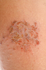 Fototapeta premium Close-up of cold urticaria on leg 