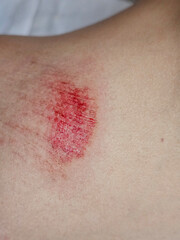 Fototapeta premium Injury with fresh blood on skin revealing a detailed view of abrasion on the body concept