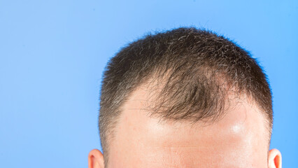 Obraz premium A man with a shaved head is looking at the camera. Concept of confidence and self-assurance, as the man's bald head is a symbol of his strength and independence