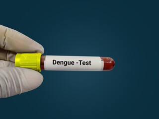 Test Tube with blood sample for dengue virus test. Doctor's hand hold blood sample with dark blue...