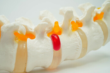 Spinal nerve and bone, Lumbar spine displaced herniated disc fragment, Model for treatment medical...