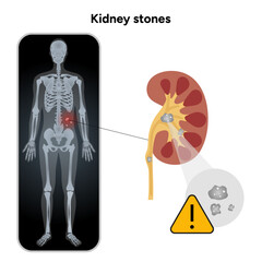 Human urine pain, diagnosis ureter, kidney stones in x ray. Urologist medical disease 