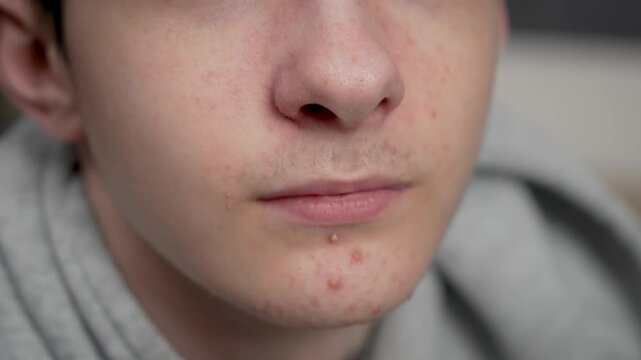 Teenage acne on facial skin during puberty. Pimples on teenager face adolescence. Acne breakouts on skin of adolescent typical of puberty