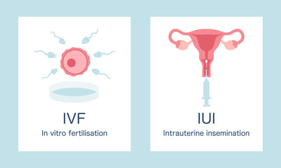 In vitro fertilization IVF and intrauterine insemination IUI infographic posters set. Egg, sperm, uterus and syringe illustration in cartoon flat style
