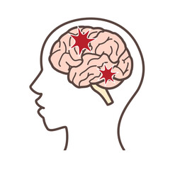 ダメージを受けた脳のイラスト