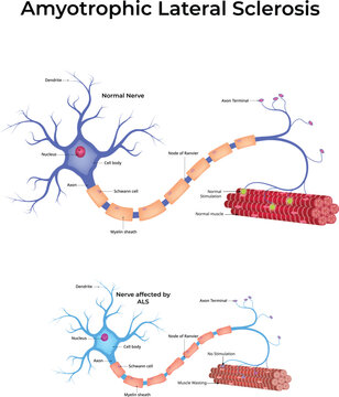 Amyotrophic Lateral Sclerosis ALS Design Vector Illustration