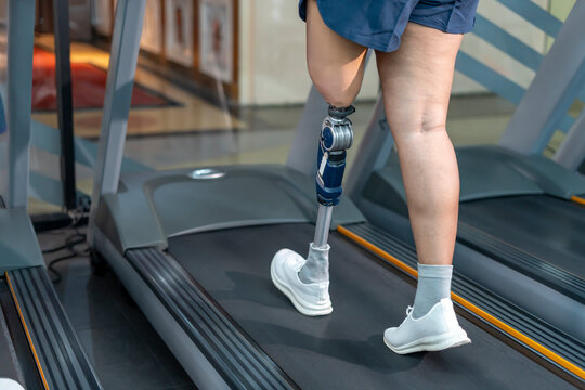 A person with prosthetic leg walking on treadmill at gym,athletic woman exercising in fitness club