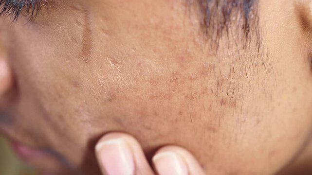 Acne scars and marks on face