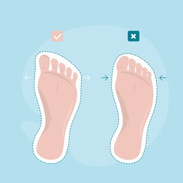 Abnormal of foot shape from deformity joint connecting big toe. Problem of foot form wearing high heel make. Barefoot shoes care. compare healthy and deformity feet.