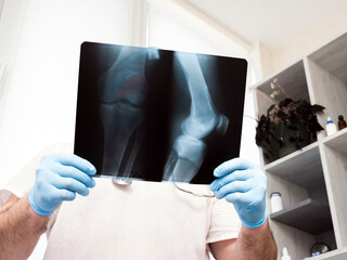 Doctor in the clinic, traumatologist analyzes a broken leg. X-ray of the knee. Ultrasound. Injury of the leg in the knee joint. Osteoporosis
