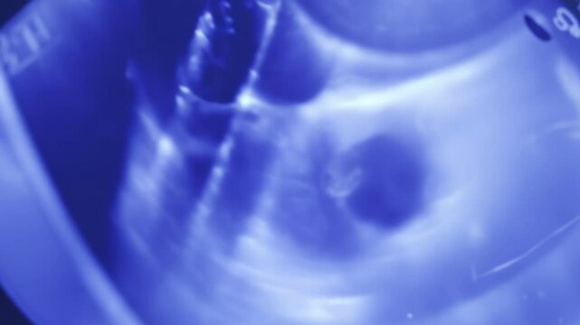 Medical ultrasound examination showing prostate gland