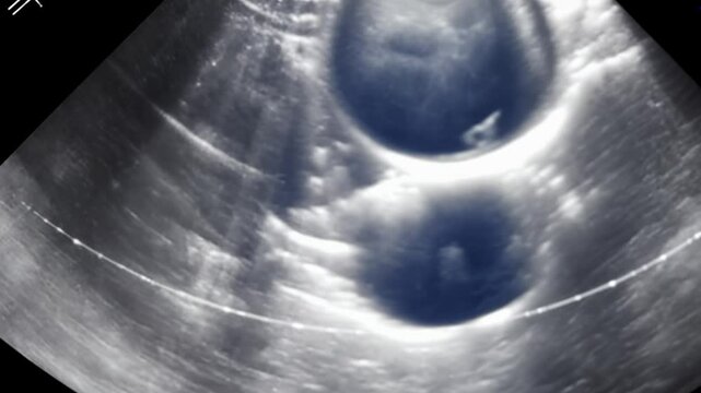 Ultrasound examination showing two embryos